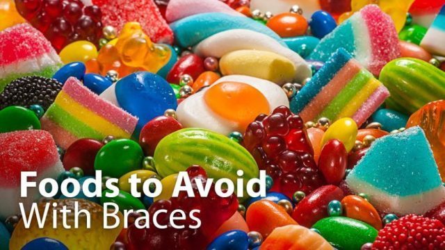 Foods to avoid after a braces adjustment