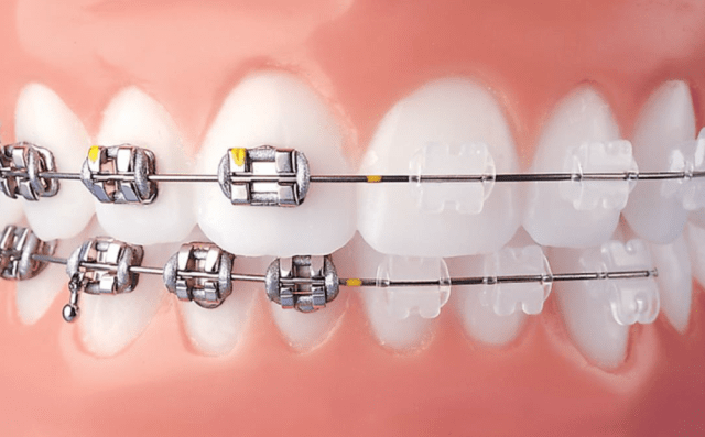 Clear bracket braces vs metal